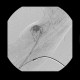 Neovascularisation in tumour of biceps brachii: AG - Angiography